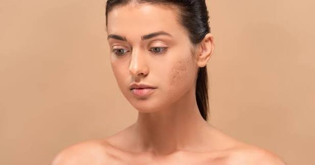 fade dark spots naturally